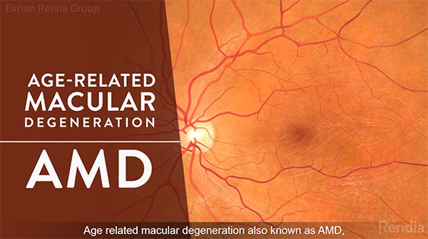 Macular Degeneration (AMD) Treatment Baltimore – Wet & Dry AMD