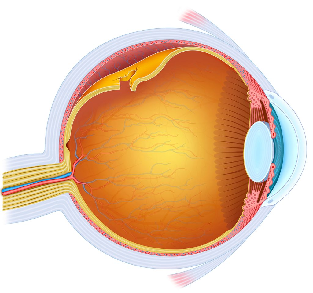 Scleral Buckling Procedure Restores Vision After a Detached Retina