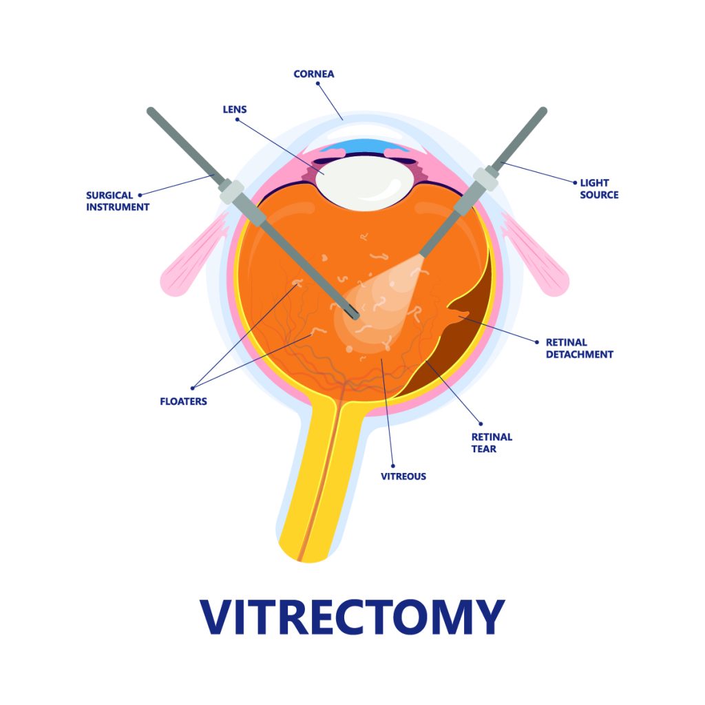 When Is Vitrectomy Necessary? Vitrectomy Procedure Benefits