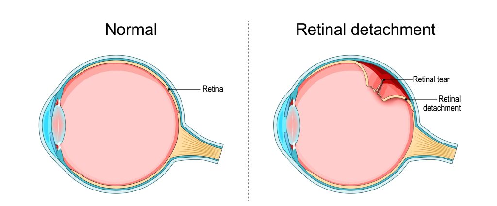 Retinal Detachment in West Orange 