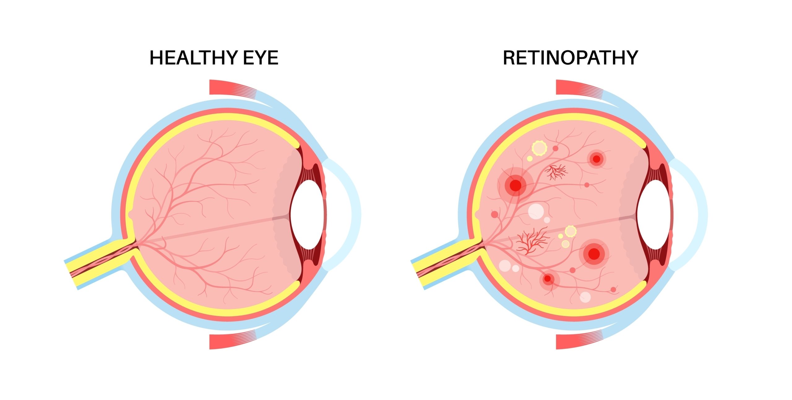 Diabetic Retinopathy Rosedale, Glen Burnie, Pikesville & Catonsville, MD