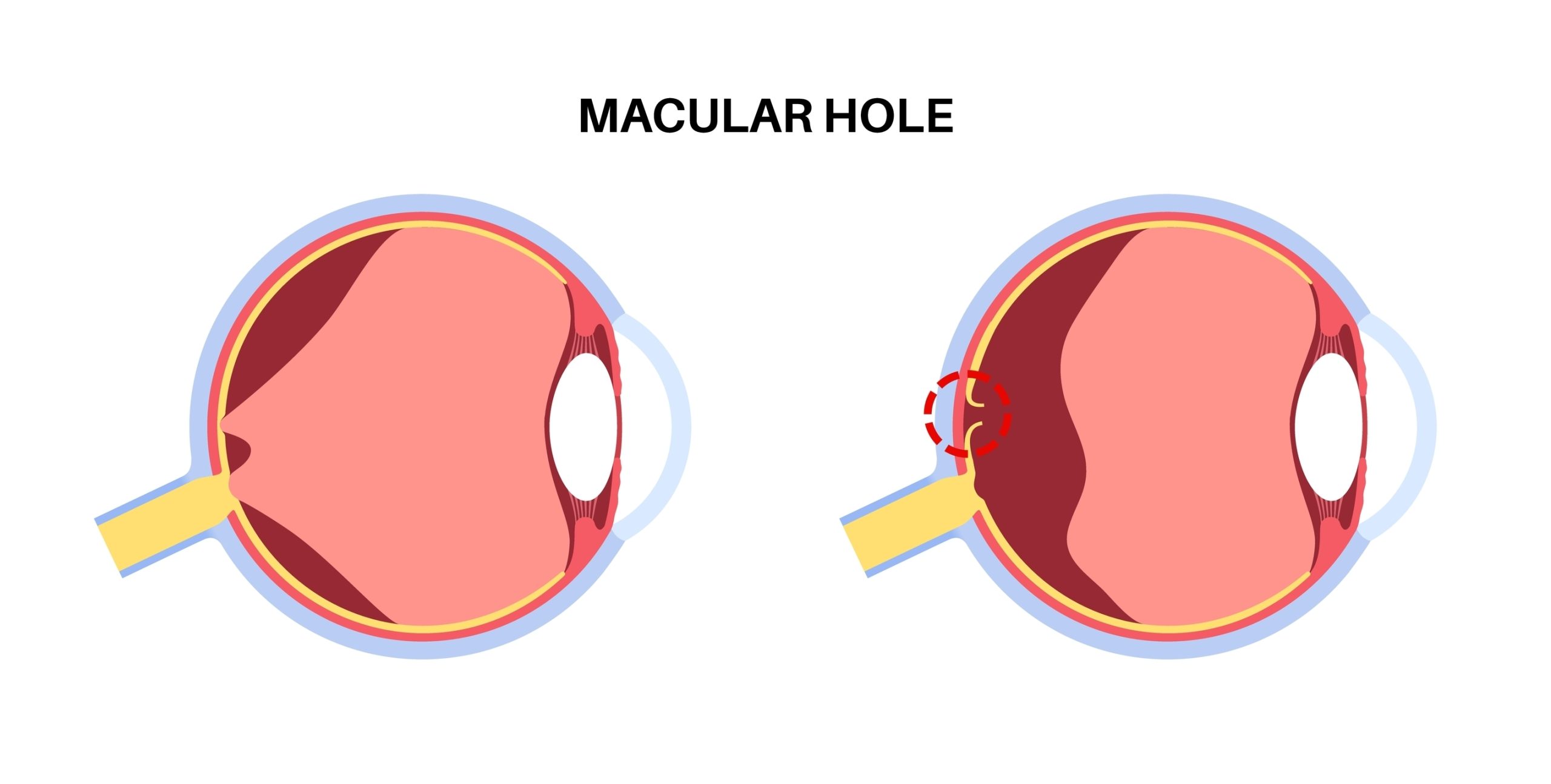 Macular Holes Rosedale, Glen Burnie, Pikesville & Catonsville, MD