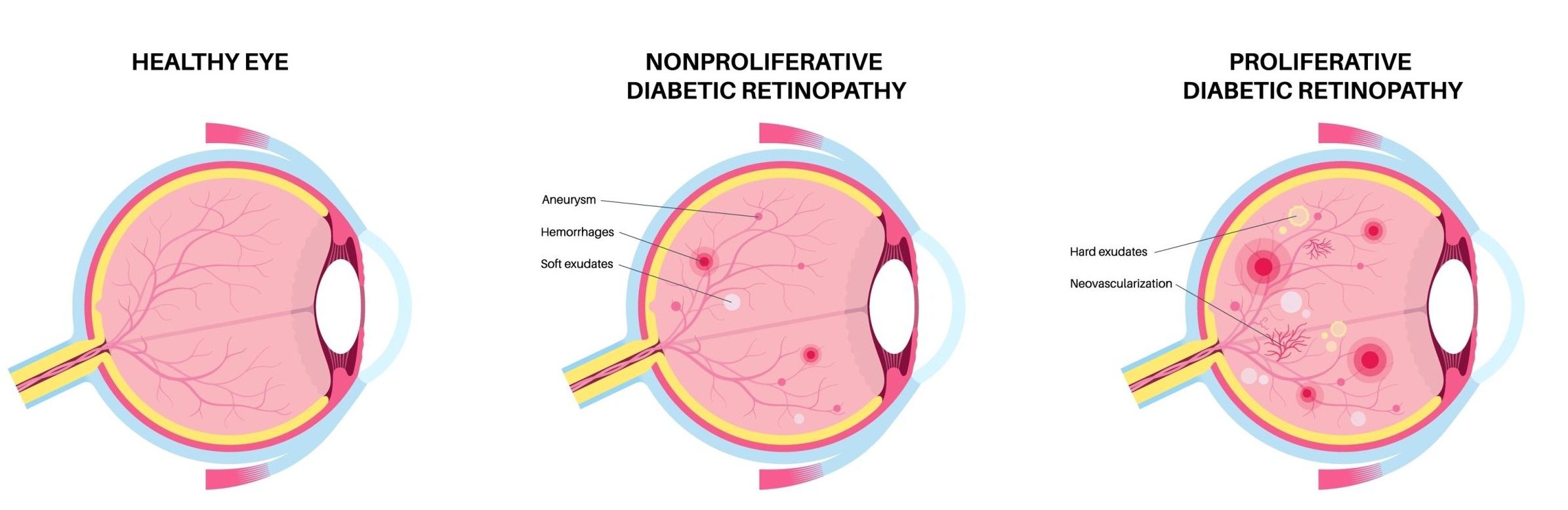 Diagram shows a healthy eye, non-proliferative diabetic retinopathy and proliferative diabetic retinopathy.